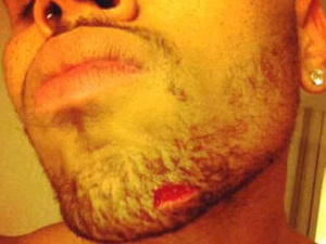 Chris Brown's cut chin