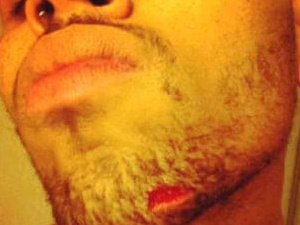 Chris Brown's cut chin