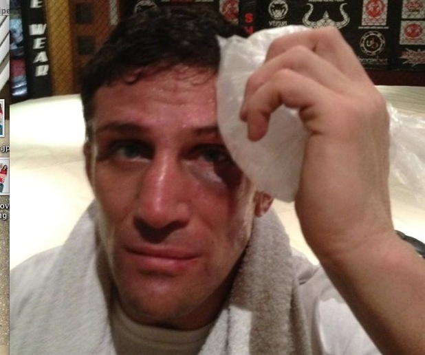 Alex Reid places ice on his black eye