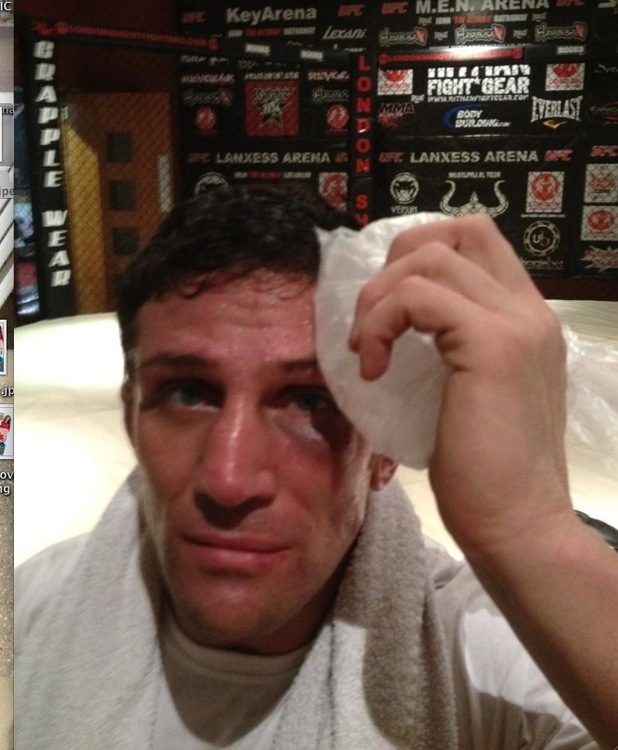 Alex Reid places ice on his black eye