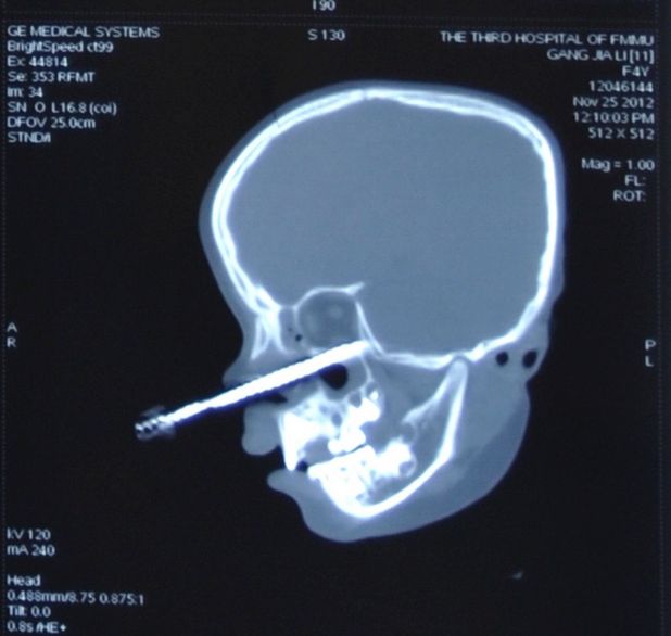 X-ray of girl impaled with screwdriver
