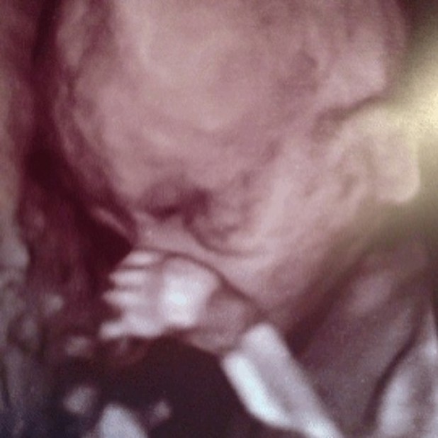Coleen and Wayne Rooney's baby scan