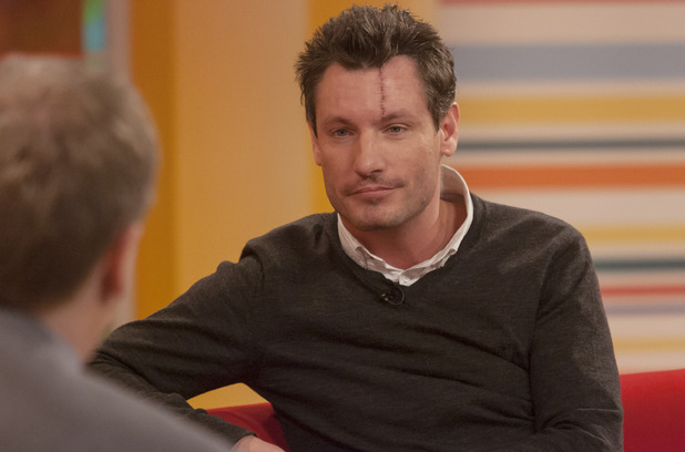 Dean Gaffney discusses his facial reconstructive surgery on 'Daybreak'