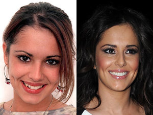 Cheryl Cole, teeth, before, after
