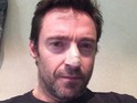 Actor urges fans to use sunscreen after suffering from a basal cell carcinoma.